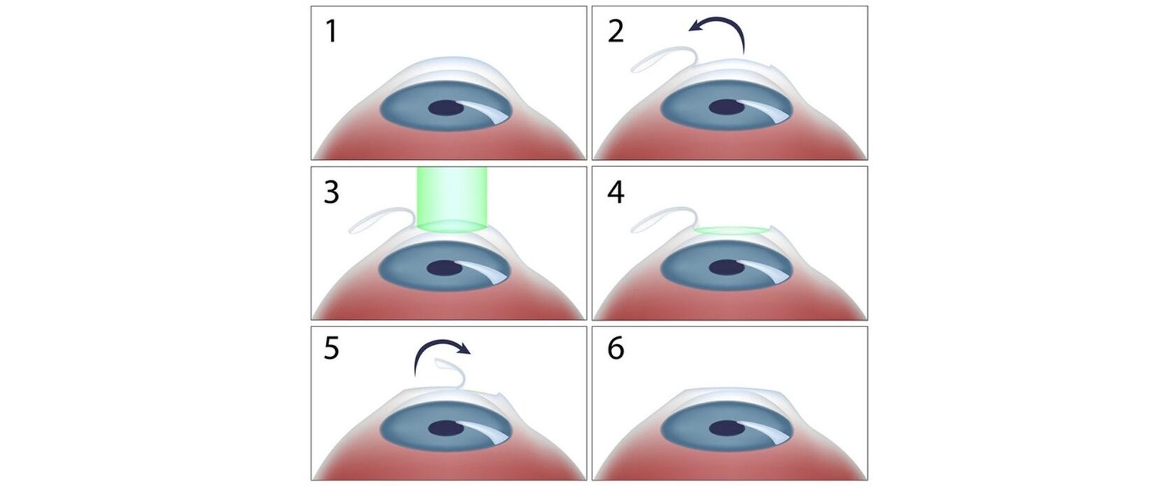 Лазерная установка для LASIK